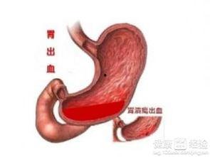 吃瓜胃出血